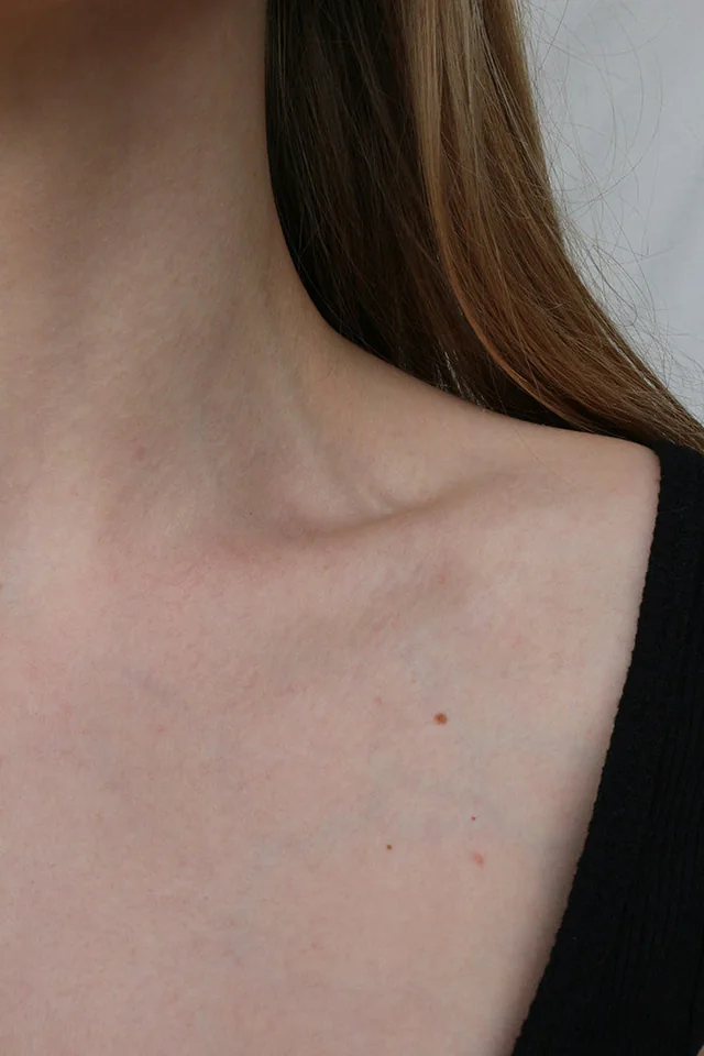 Aging Neck Treatments