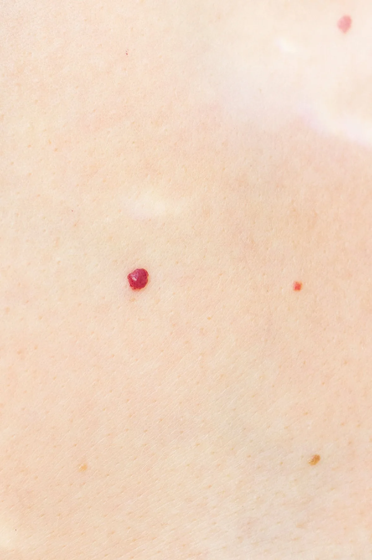 Cherry Angioma
