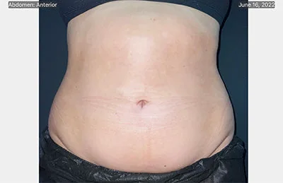 CoolSculpting® — after, result 1