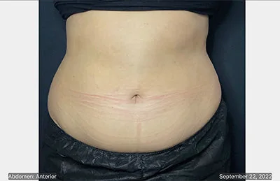 CoolSculpting® — before, result 1