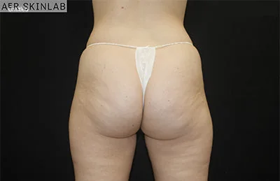 CoolSculpting® — before, result 2