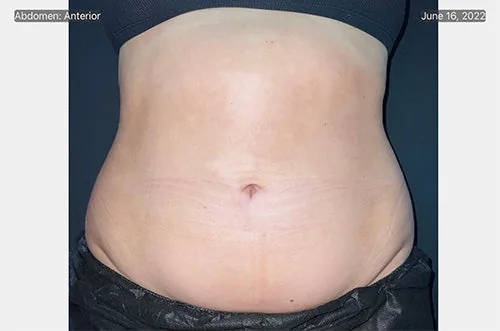 CoolSculpting® — before, result 4