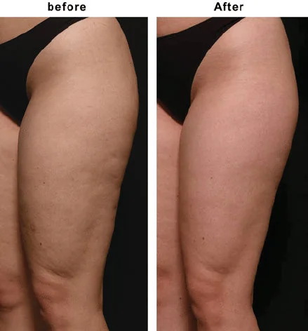 Skin Dimple Treatment at AE.R Skinlab