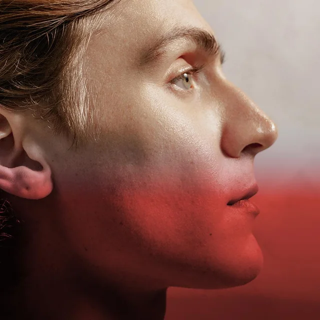 IPL Rosacea Treatment