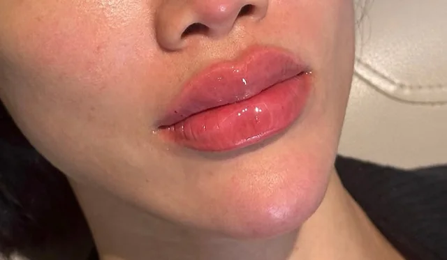 Lip Filler