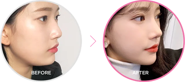 Non-Surgical Rhinoplasty treatment at AE.R Skinlab