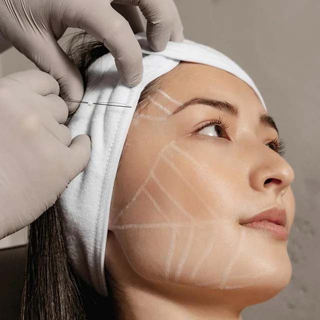 Threadlift