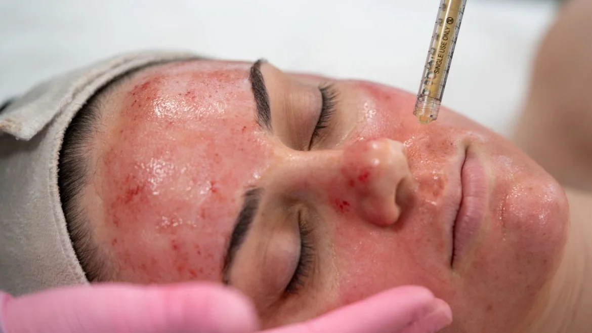 Vampire PRP Facelift